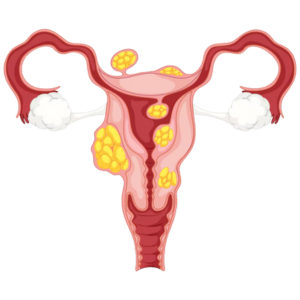 Fibroids Cause Infertility